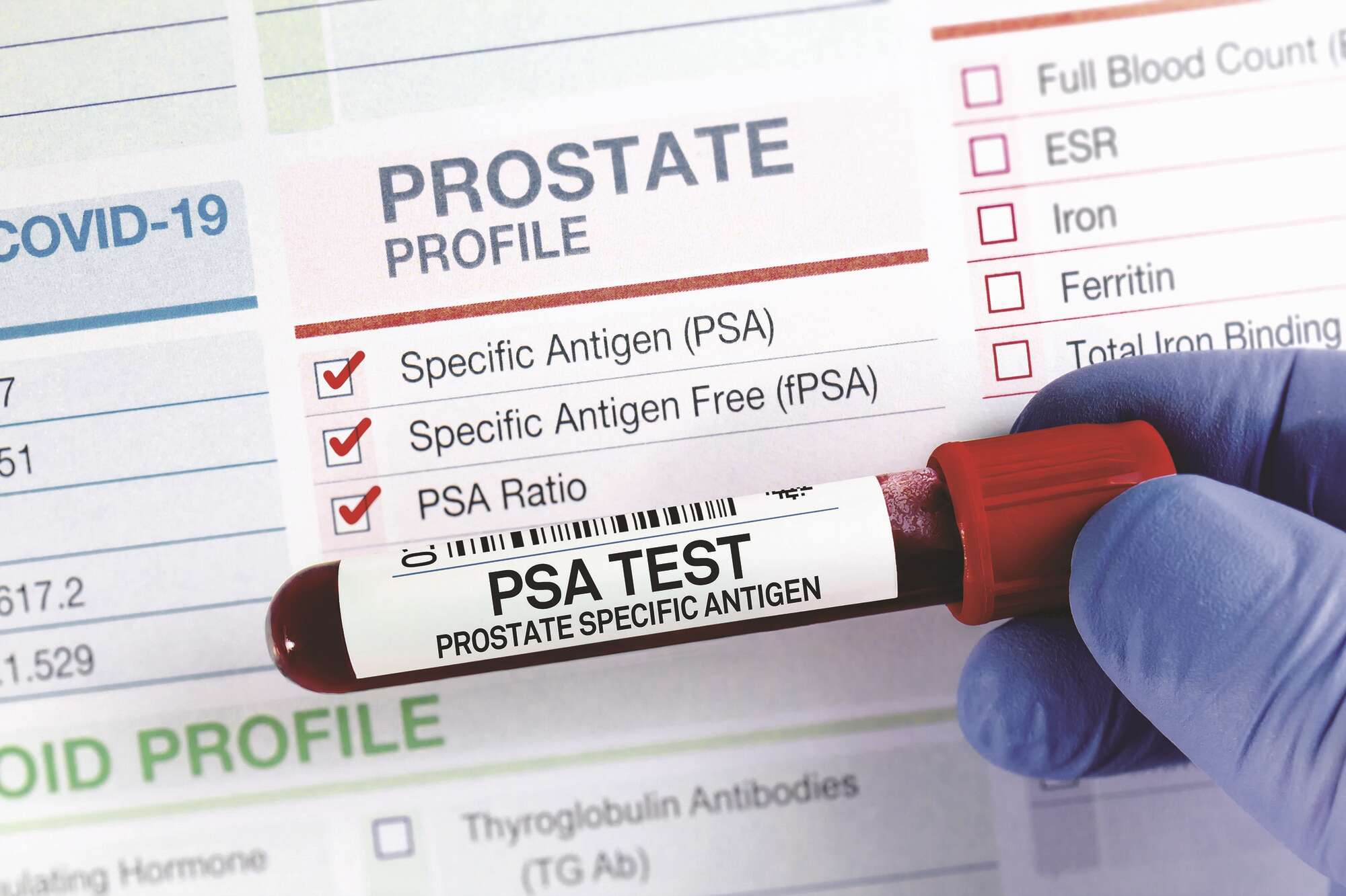 Alternative to surgery for early-stage prostate cancer - Vimarsana News