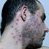 monkeypox