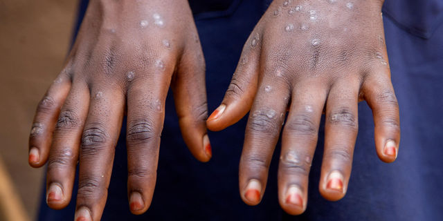 Kenya reports first mpox death, positive cases rise to 13 - The EastAfrican