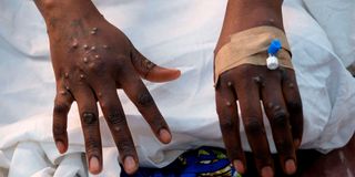 Mpox